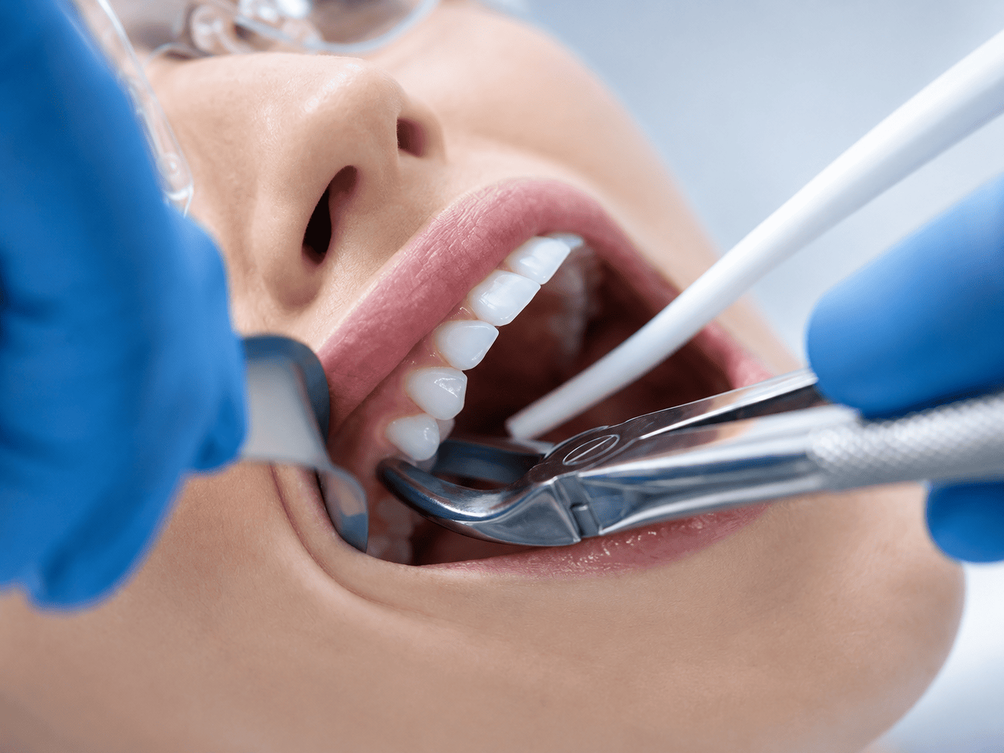 Extracciones Dentales